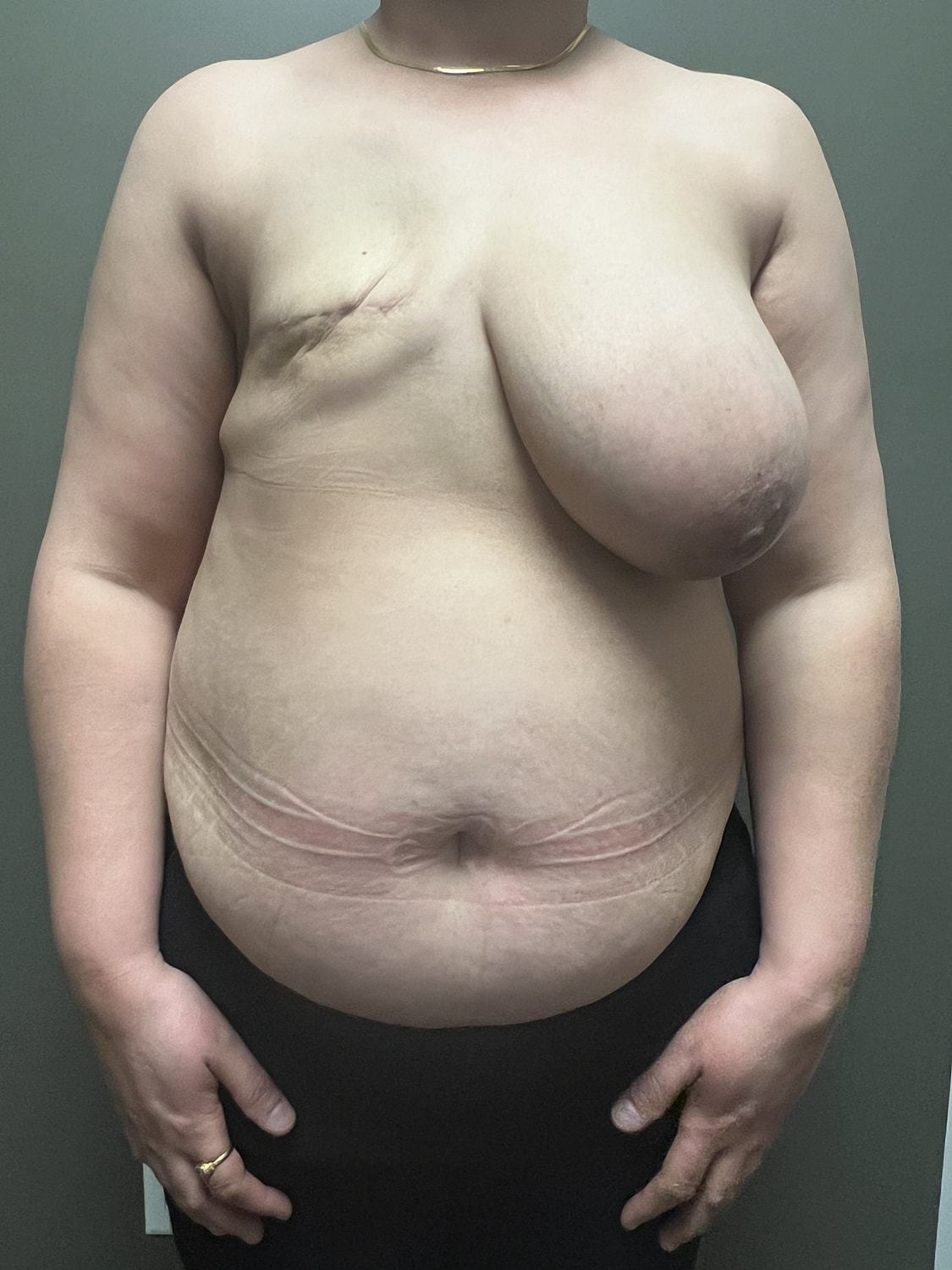 Breast and abdomen with visible skin changes.