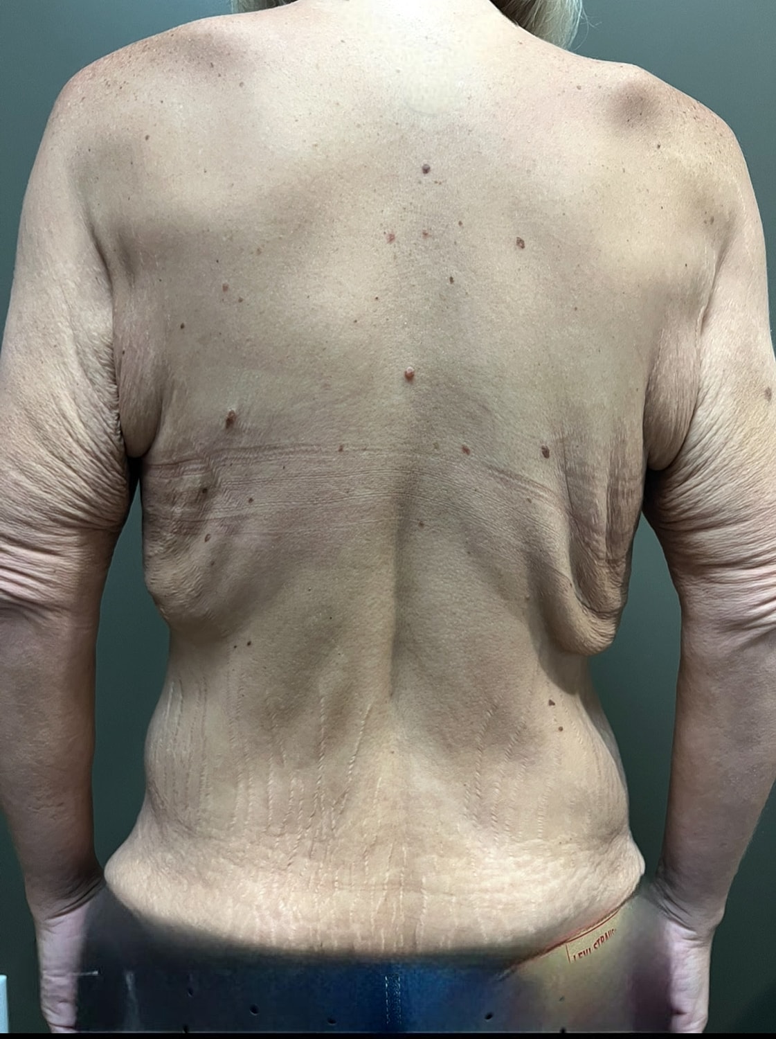 Back view of a person with skin changes.